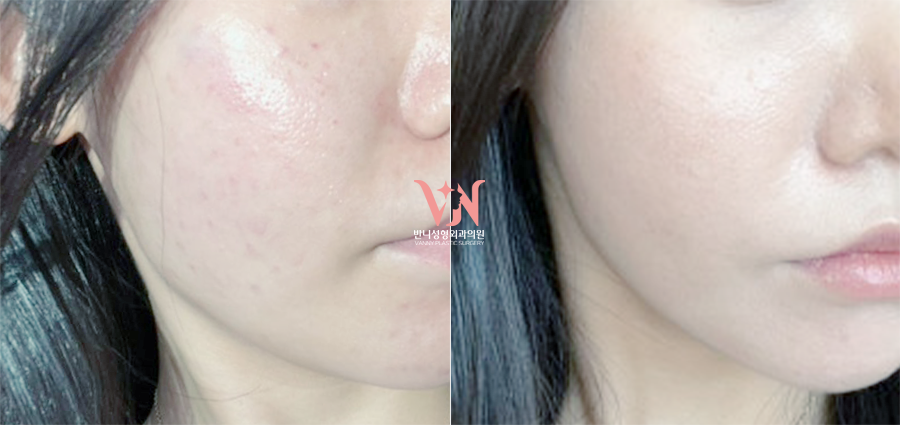 Before-and-after comparison for combined Rejuran and Juvelook treatment, case 267